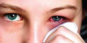 ඇස කසනවා කඳුළු එනවා - Ocular allergy (Allergic conjunctivitis)
