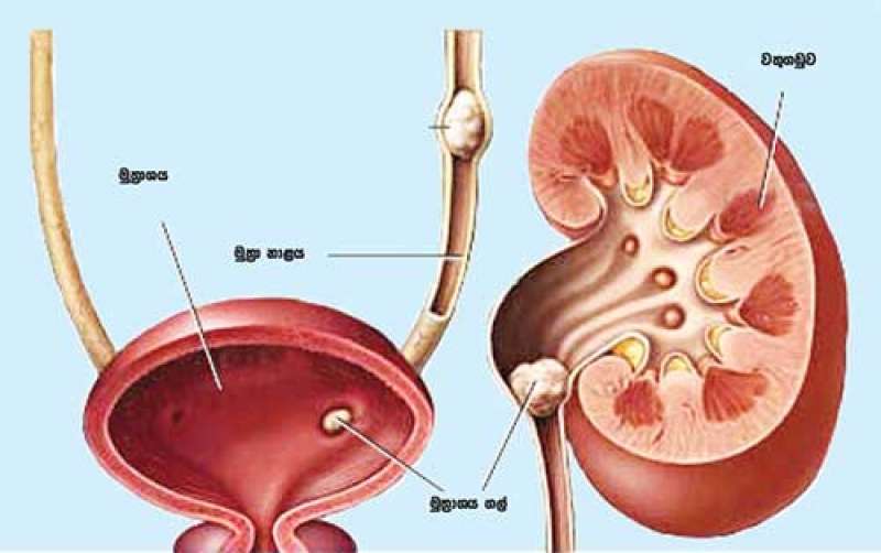 මූත්‍රා ගල් ඇති වන්නේ ඇයි ?