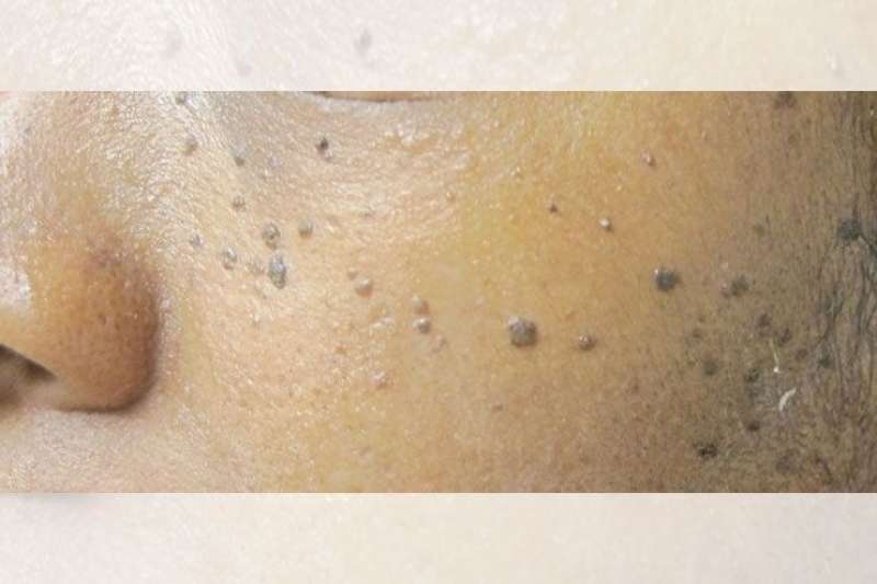 Black marks on Skin